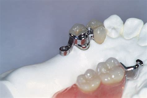 zirca metal housing attachments denture|ERA Attachments .